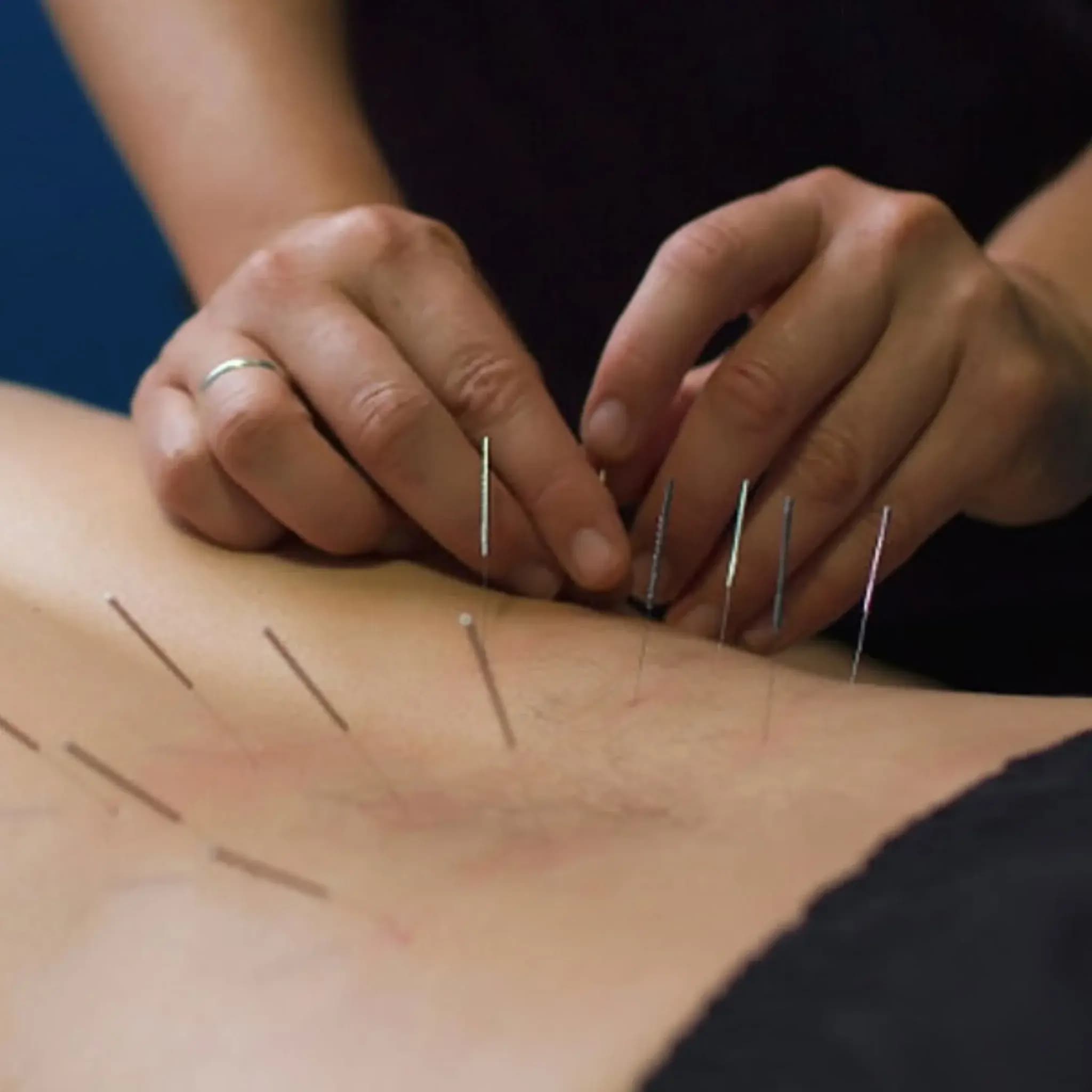 The Benefits of Dry Needling for Athletes